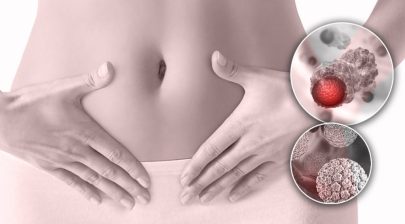 درمان زگیل تناسلی با دکتر مدبری